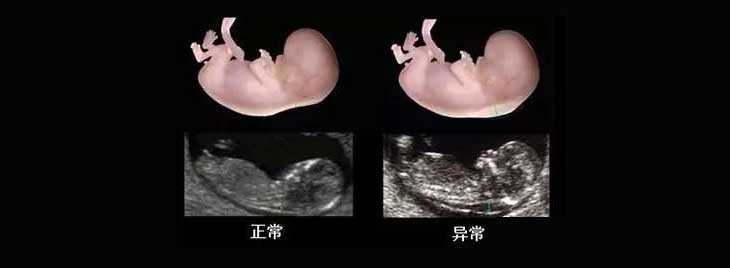 广州传承生殖中心创立于多少年[那家代孕做的好]+试管婴儿nt检查什么