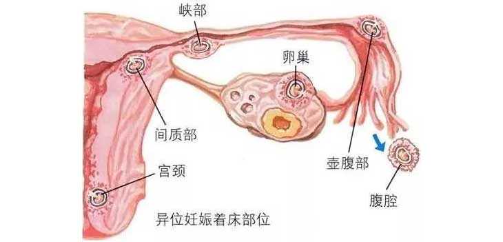 临沧代孕官方中介_鹤壁试管婴儿移植后，出血了是着床失败吗？怎么办？